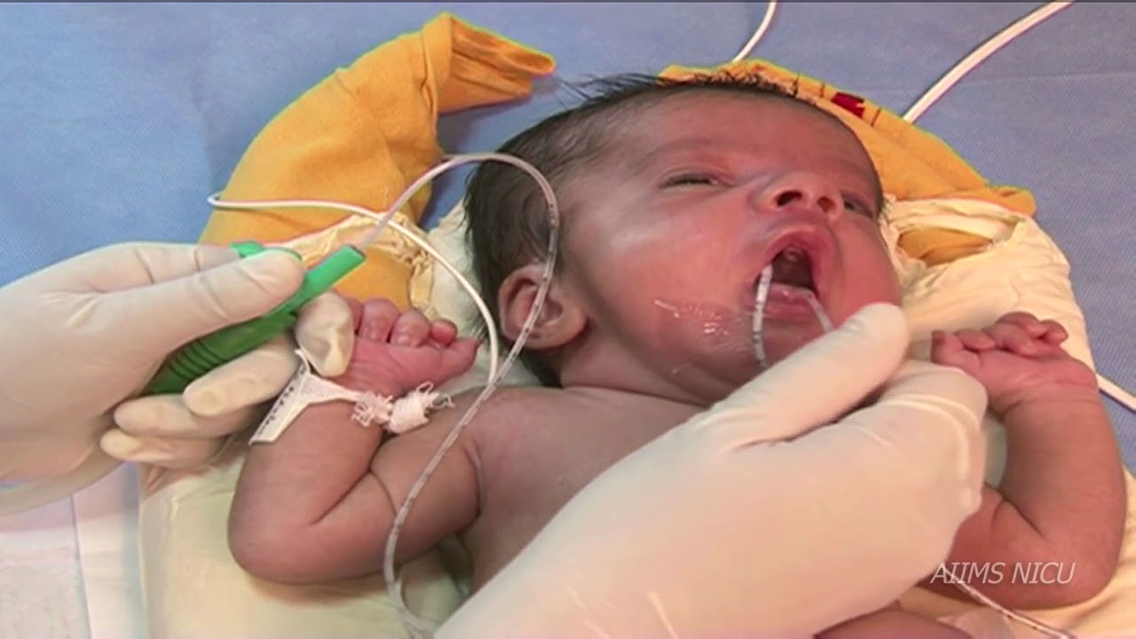 Infant Oro-Nasopharyngeal Suctioning