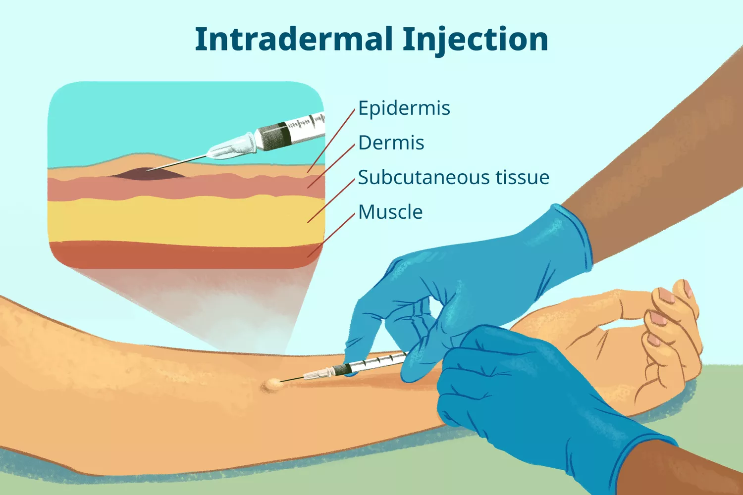Intradermal Injection Site